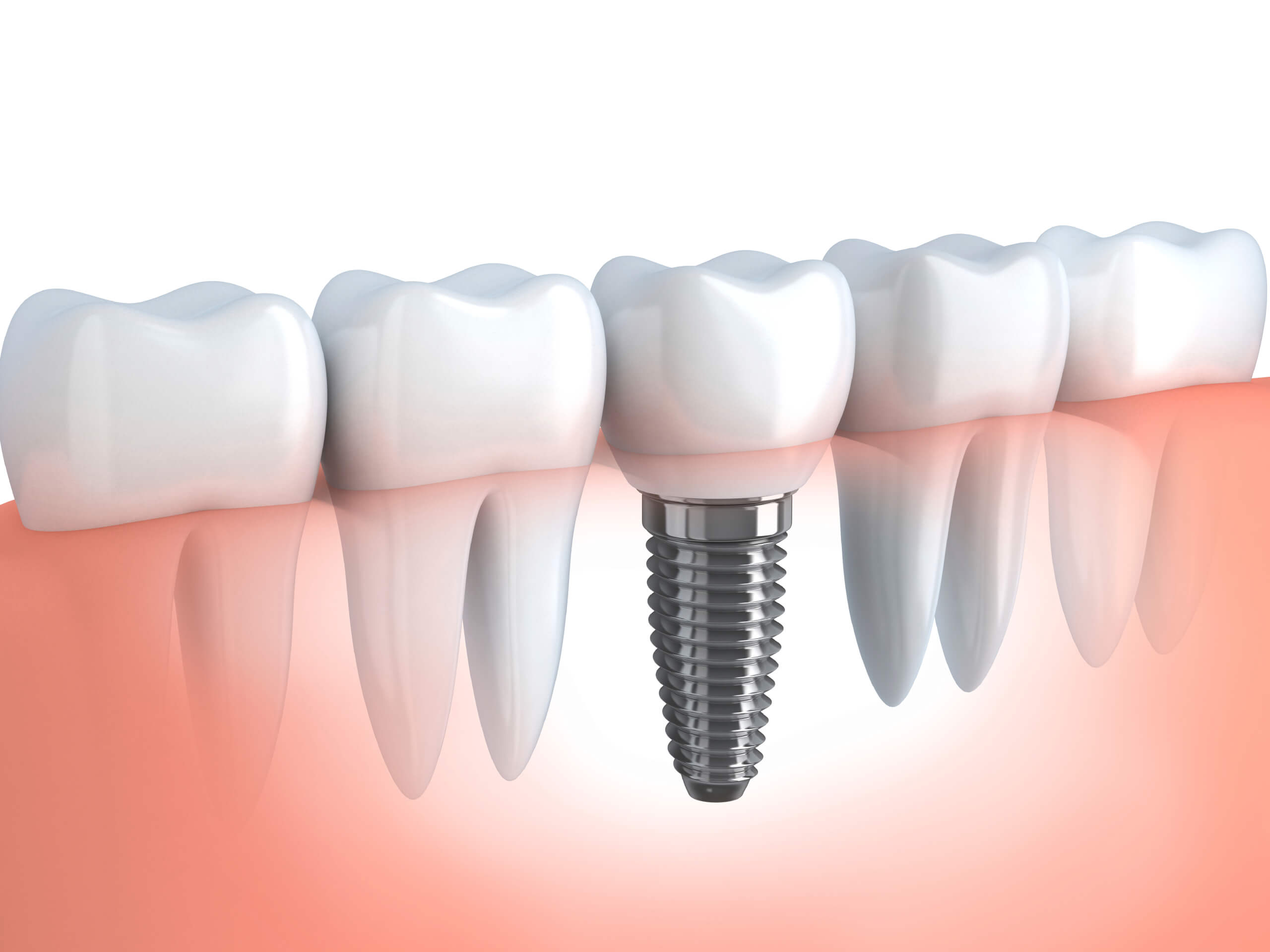 Имплантация зубов: какие виды имплантатов существуют